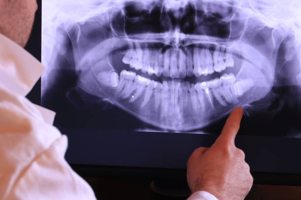Best Emergency Tooth Extraction in Champlin, MN